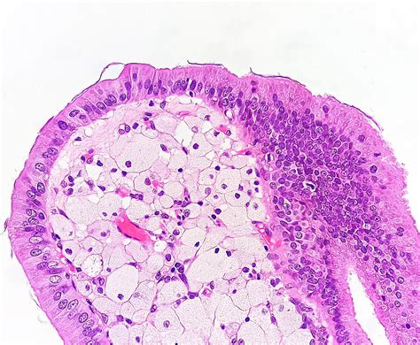 Pathology Outlines - Cholesterolosis