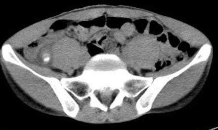 Retrocecal appendicitis | Image | Radiopaedia.org