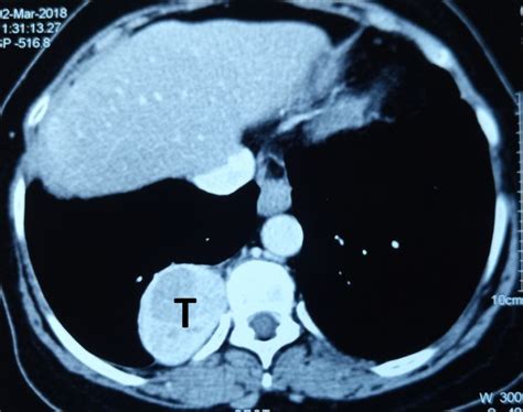 CECT chest showing a typical posterior mediastinal neurogenic tumor ...