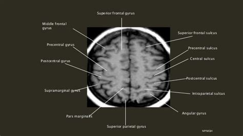 Sulcal anatomy supratentorial brain, excluding the temporal lobe.