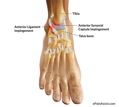 What is Ankle Impingement|Symptoms|Causes|Treatment|Recovery Period|Exercises