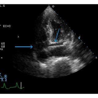 (PDF) The Incidental Finding of a Persistent Left Superior Vena Cava: Implications for Primary ...