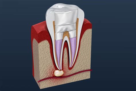 Common Root Canal Complications | Dr. Tracey Mulhall