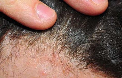 Different Types Of Dandruff And How To Stop Them | Remédio para caspa, Cuidados com a pele ...