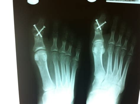 Foot and Ankle Problems By Dr. Richard Blake: Big Toe Joint Fusion ...