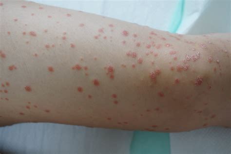 What Does Guttate Psoriasis Look Like? | Prosoria Psoriasis Treatment – Nuvothera™