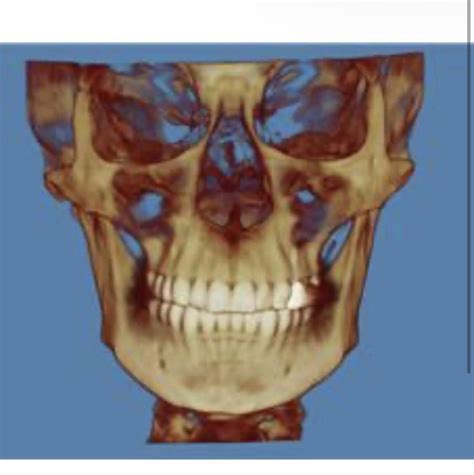 What causes this kind of asymmetry? Left side is less developed than ...