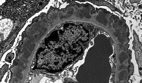 Membranous Nephropathy | Basicmedical Key