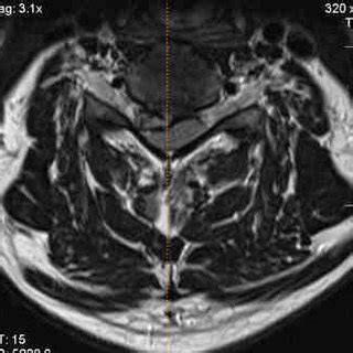 -MRI scan: Left C6 – C7 herniated disc Figure 5 -MRI scan: Left C6 – C7 ...