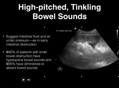 Bowel sounds/ultrasound | Block 3 Session 2: Bowel sounds/ultrasound ...