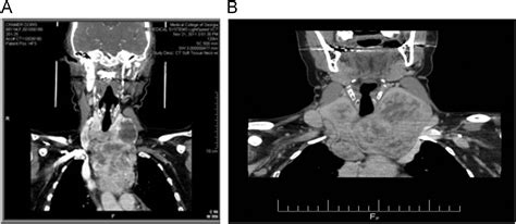 Substernal thyroidectomy: The transcervical approach - Operative ...