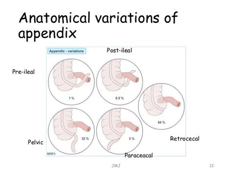 Acute appendicitis