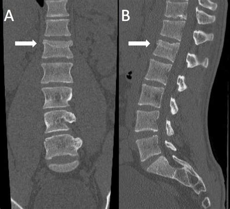 Unique Mechanism of Chance Fracture in a Young Adult Male - The Western Journal of Emergency ...