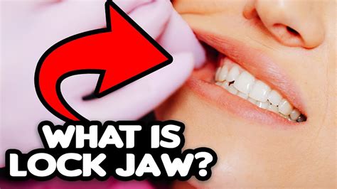 Lock Jaw Explained (causes, treatment, prevention) - YouTube