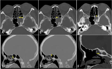 Modified sphenoidotomy for isolated sphenoid sinus disease: A series of 117 cases - Hong-Gang ...