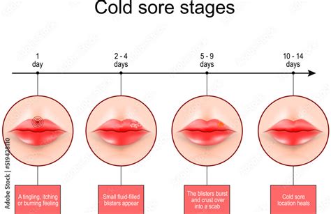 Cold sore stages. Lips with symptoms of Herpes labialis. Stock Vector ...