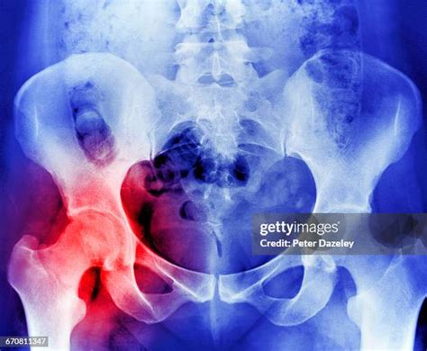 120 Hip Replacement Xray Stock Photos, High-Res Pictures, and Images - Getty Images