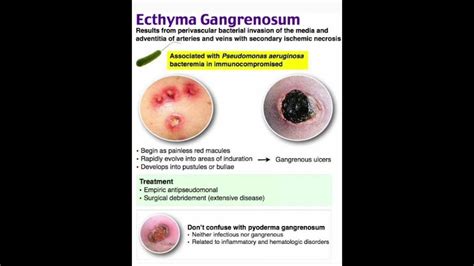 Ecthyma gangrenosum - YouTube