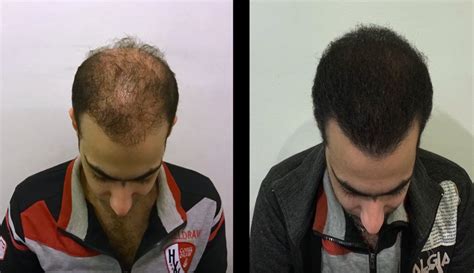 Download Best Turkey Hair Transplant Surgeons Images - Backpacker News