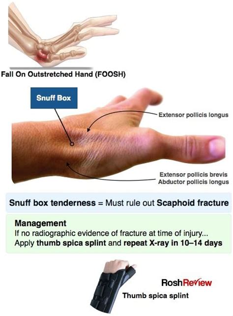 Snuff Box Tenderness, Scaphoid Fracture | Medical knowledge, Medical anatomy, Emergency medicine