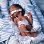 Low Birth Weight Causes | Low Birth Weight Risks | Effects & Complications