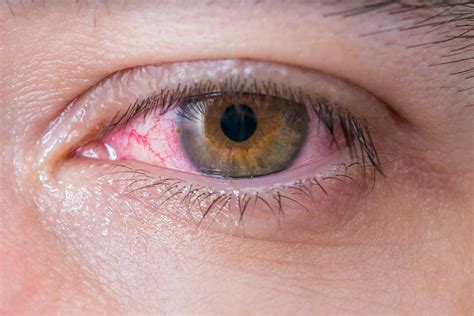 » Red Eyes – Common Symptoms, Causes, and Treatment