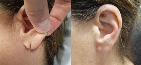 Earlobe Repair - Dr. David Seidman | ENT Queens New York