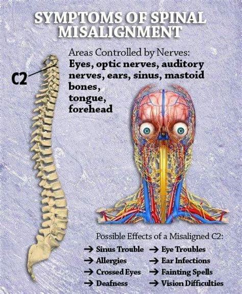 Symptoms of Spinal Misalignment Chiropractic Quotes, Chiropractic Therapy, Vértebra Cervical ...