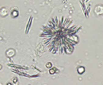 Tyrosine crystals In Urine | Medical Laboratories