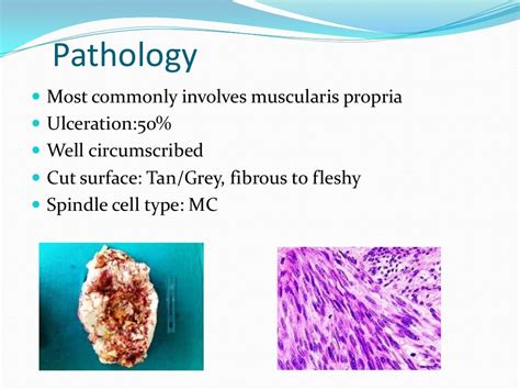 Gastrointestinal stromal tumor(gist)