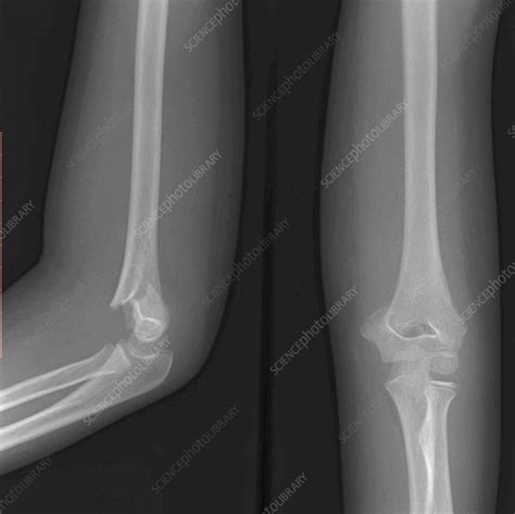 Supracondylar fracture, X-ray - Stock Image - F036/0252 - Science Photo Library