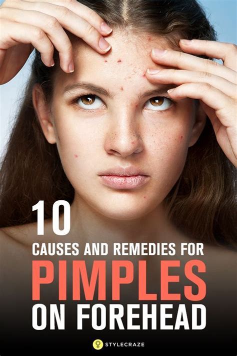 10 Home Remedies for Pimples | Pimples remedies, Pimples on forehead ...