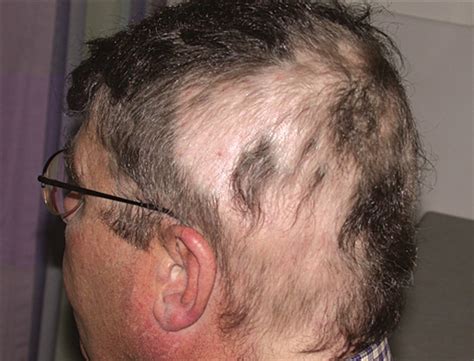 Recurrence of Alopecia Areata in a Patient Receiving Etanercept ...