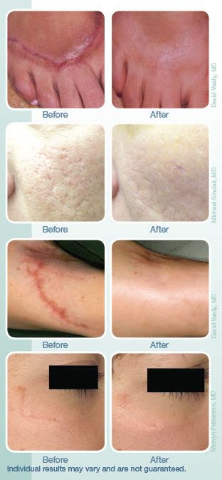 Scar Treatments Florida | Laser Scar Treatment Naples, FL | Hobdari Family Health