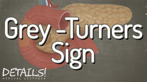 Grey Turners Sign