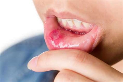 Mouth Ulcers Treatment: Types, Causes, Symptoms | Book Appointment