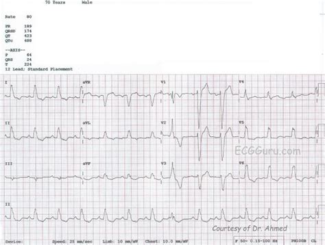 Left atrial enlargement | ECG Guru - Instructor Resources