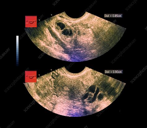 Ovarian cysts, ultrasound scan - Stock Image - M850/0652 - Science Photo Library