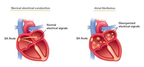 Atrial fibrillation symptoms, Atrial fibrillation, Heart conditions