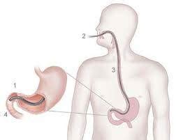 Gastroscopy Procedure | Lap Surgery Brisbane