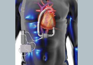 A Guide to Critical Care During the Acute Phase After LVAD Implantation - The Cardiology Advisor