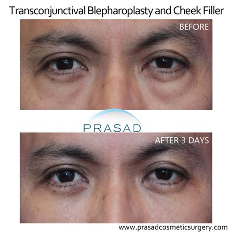 Eye Bag Surgery / Lower Blepharoplasty Recovery Process