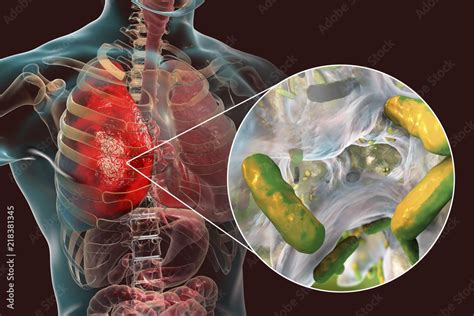 Lung infection caused by bacteria Pseudomonas aeruginosa, 3D illustration. Nosocomial pneumonia ...