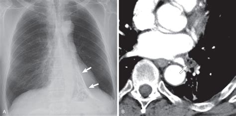 Pulmonary Hamartoma | Radiology Key