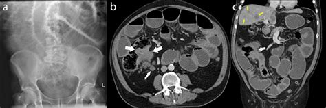 Obstructing Caecal Carcinoma - Radiology at St. Vincent's University Hospital