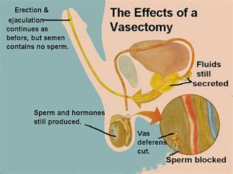 Getting A Vasectomy – How Much Does It Cost?