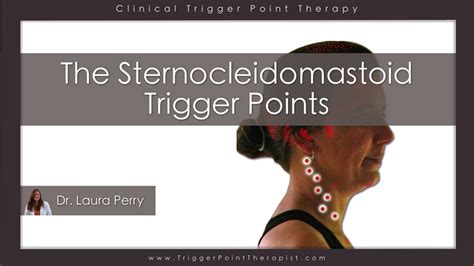 Sternocleidomastoid Trigger Points: Master of the Migraine ...