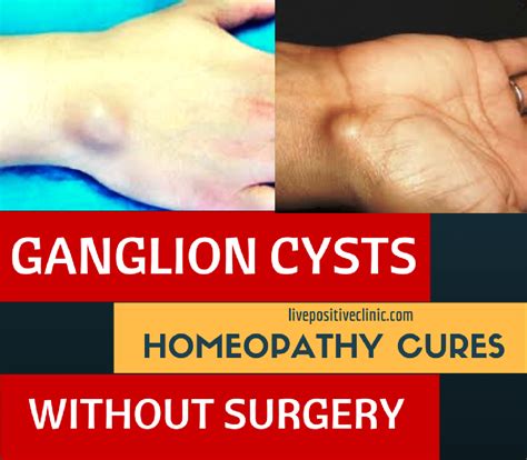 Ganglion Cyst Homeopathy [Cures Without Surgery] | LIVE POSITIVE