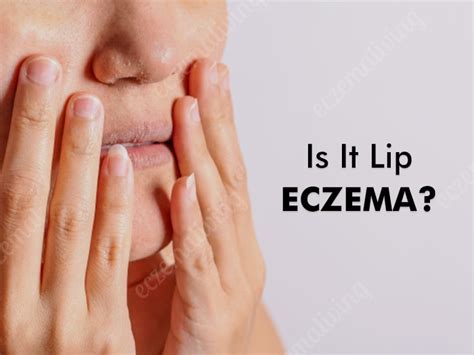 Eczema on Lips - Causes, Symptoms, Treatment & Home Remedies