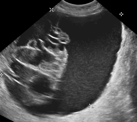 Transabdominal pelvic ultrasound of right adnexal mass measuring 22.5 ×... | Download Scientific ...